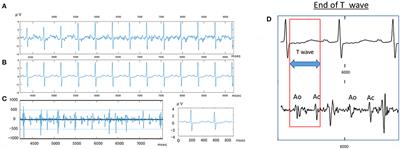 Evaluation of Abdominal Fetal Electrocardiography in Early Intrauterine Growth Restriction